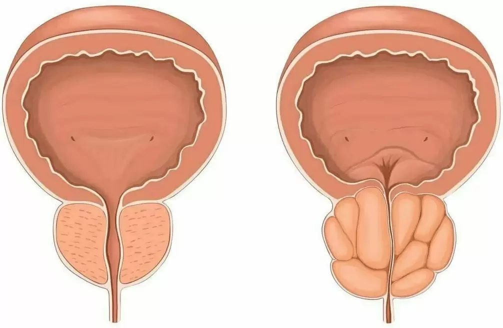 Normal prostate and sore prostate