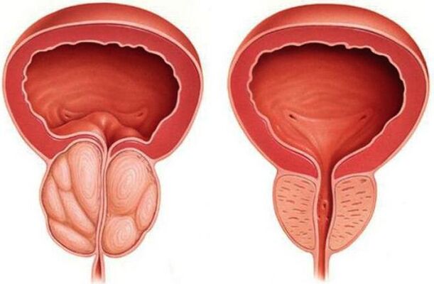 healthy and inflamed prostate with prostatitis